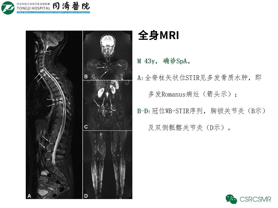 【PPT】各种影像技术对诊断骶髂关节炎的价值