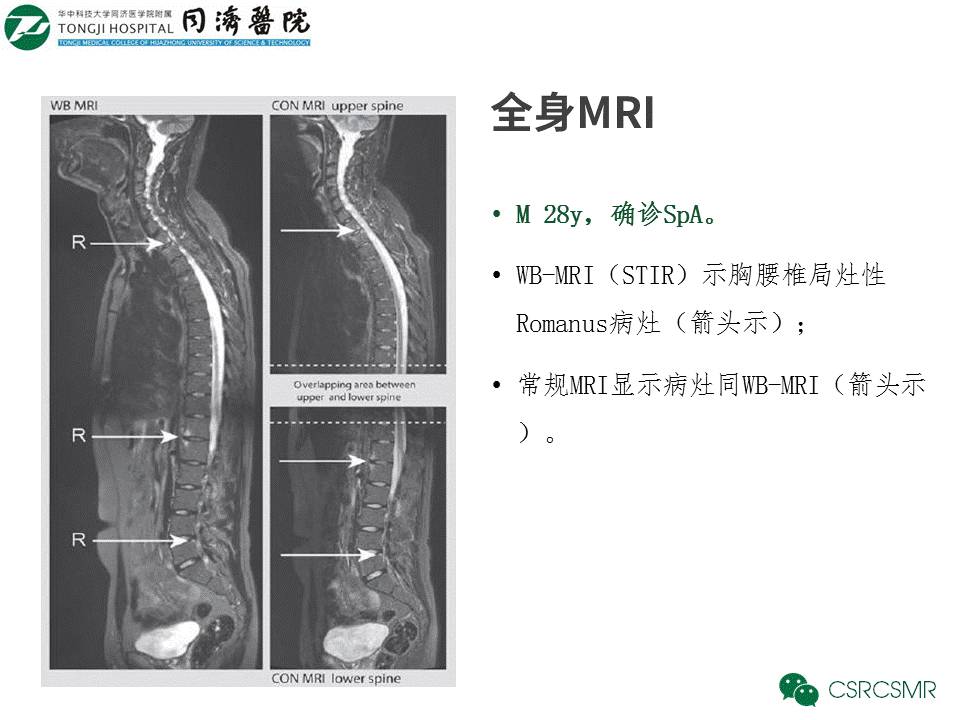 【PPT】各种影像技术对诊断骶髂关节炎的价值