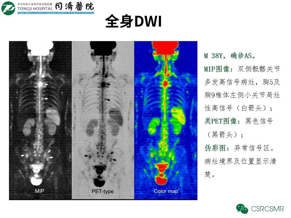 【PPT】各种影像技术对诊断骶髂关节炎的价值