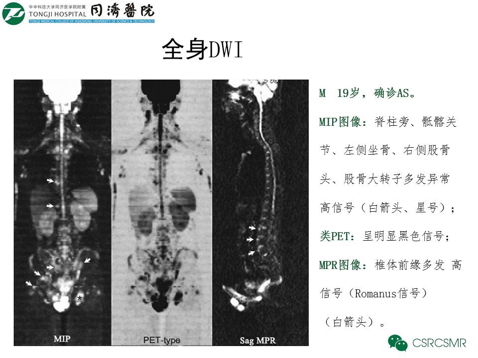 【PPT】各种影像技术对诊断骶髂关节炎的价值