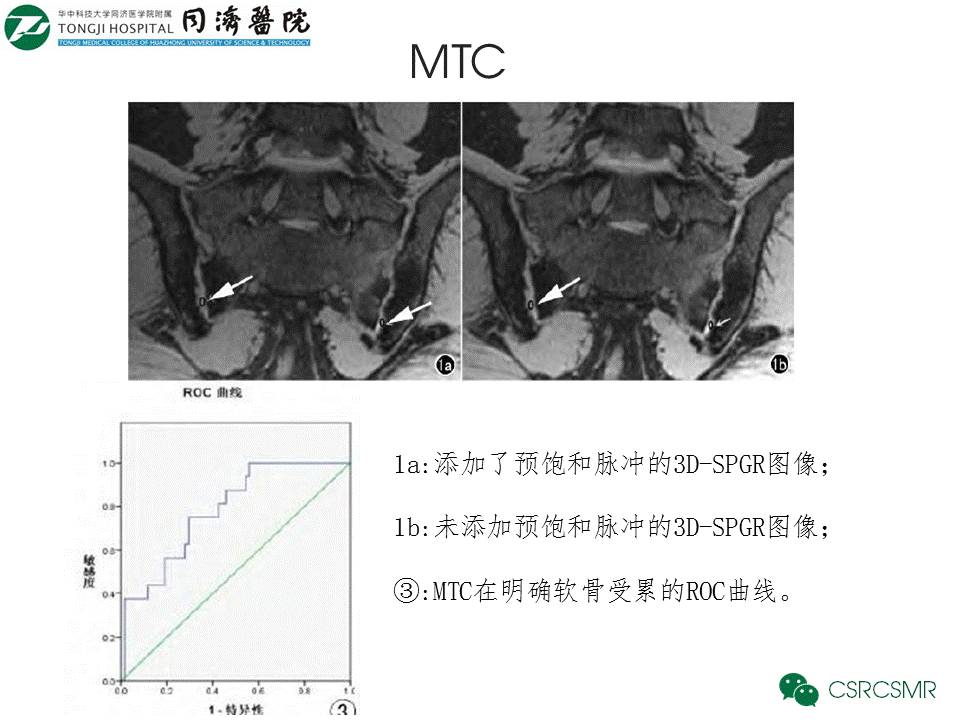【PPT】各种影像技术对诊断骶髂关节炎的价值