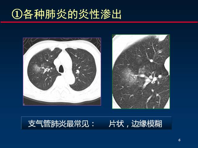 【PPT】肺实质与支气管——基本CT征象的定义与诠释