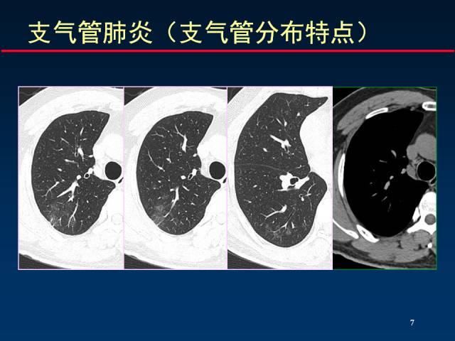 【PPT】肺实质与支气管——基本CT征象的定义与诠释