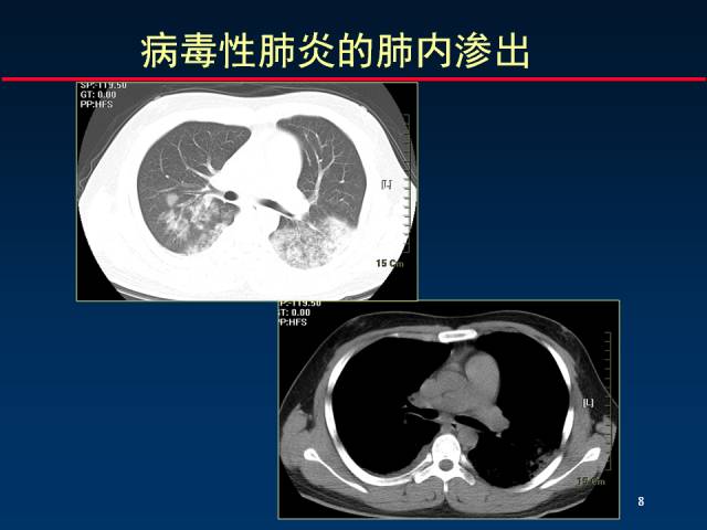 【PPT】肺实质与支气管——基本CT征象的定义与诠释