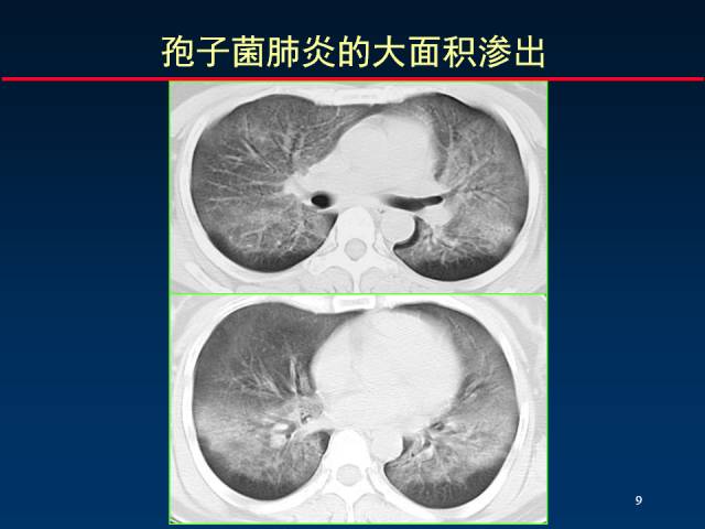 【PPT】肺实质与支气管——基本CT征象的定义与诠释
