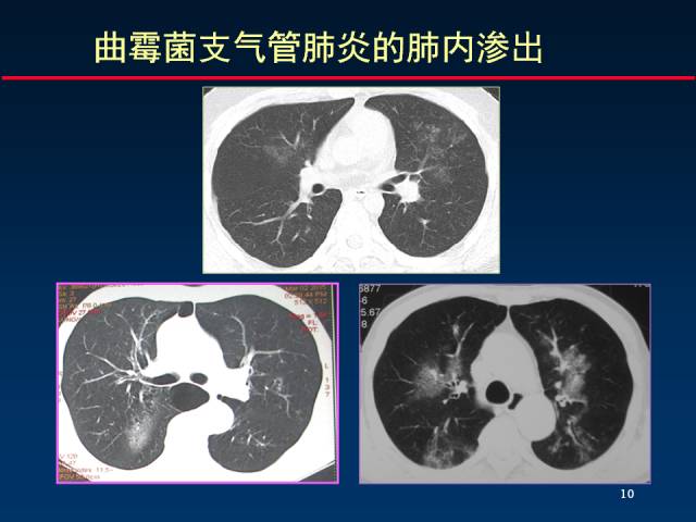 【PPT】肺实质与支气管——基本CT征象的定义与诠释