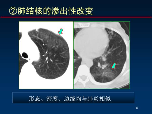 【PPT】肺实质与支气管——基本CT征象的定义与诠释