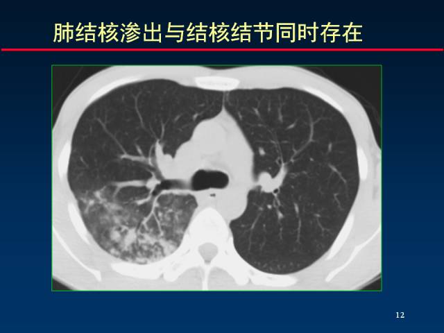 【PPT】肺实质与支气管——基本CT征象的定义与诠释