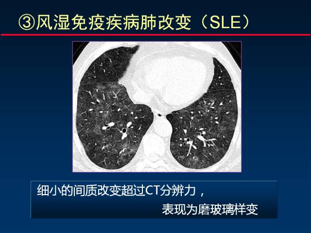 【PPT】肺实质与支气管——基本CT征象的定义与诠释