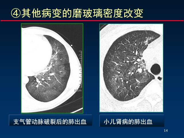 【PPT】肺实质与支气管——基本CT征象的定义与诠释