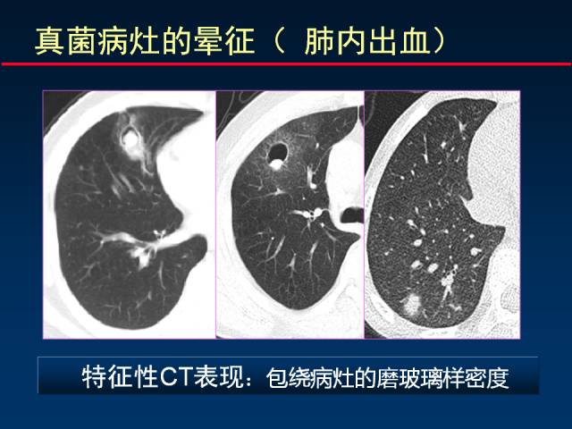 【PPT】肺实质与支气管——基本CT征象的定义与诠释