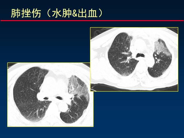 【PPT】肺实质与支气管——基本CT征象的定义与诠释