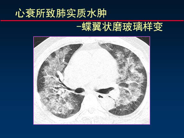 【PPT】肺实质与支气管——基本CT征象的定义与诠释