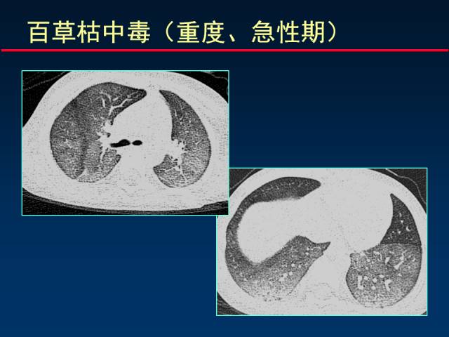 【PPT】肺实质与支气管——基本CT征象的定义与诠释