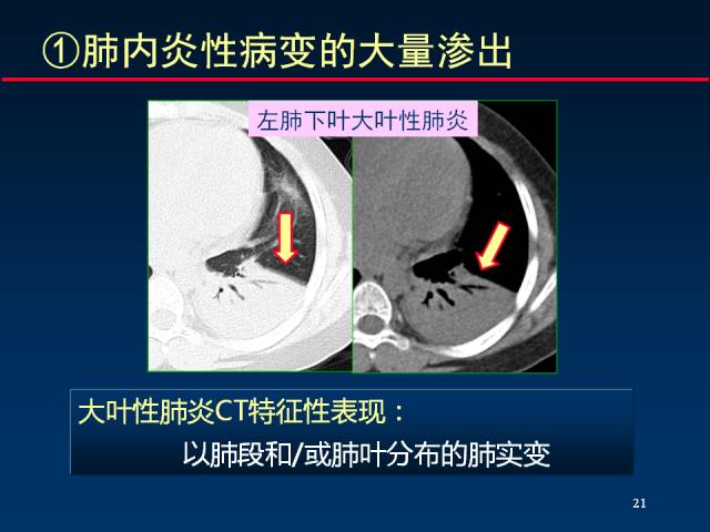 【PPT】肺实质与支气管——基本CT征象的定义与诠释