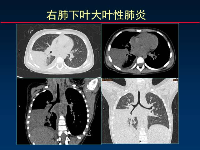 【PPT】肺实质与支气管——基本CT征象的定义与诠释