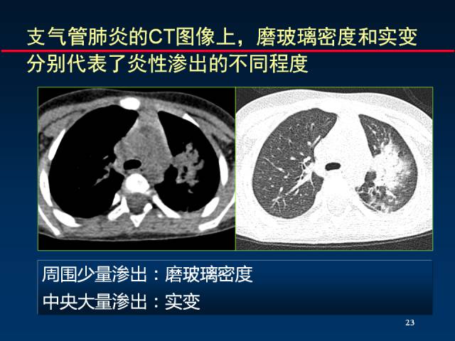 【PPT】肺实质与支气管——基本CT征象的定义与诠释