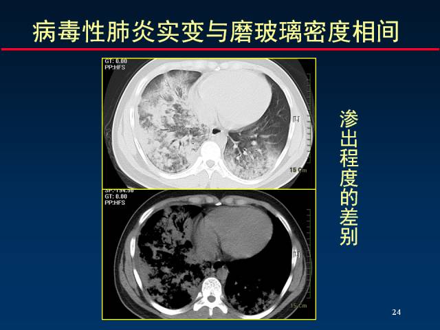 【PPT】肺实质与支气管——基本CT征象的定义与诠释