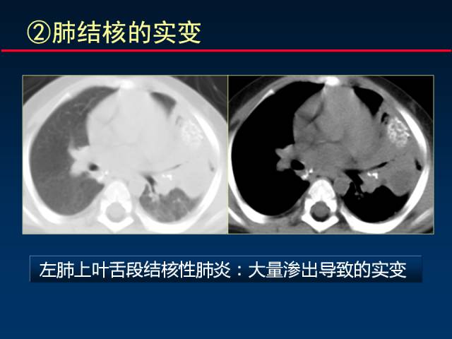 【PPT】肺实质与支气管——基本CT征象的定义与诠释