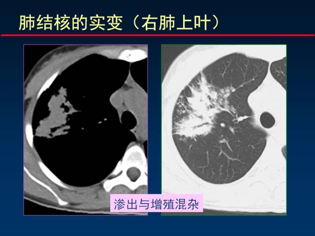 【PPT】肺实质与支气管——基本CT征象的定义与诠释
