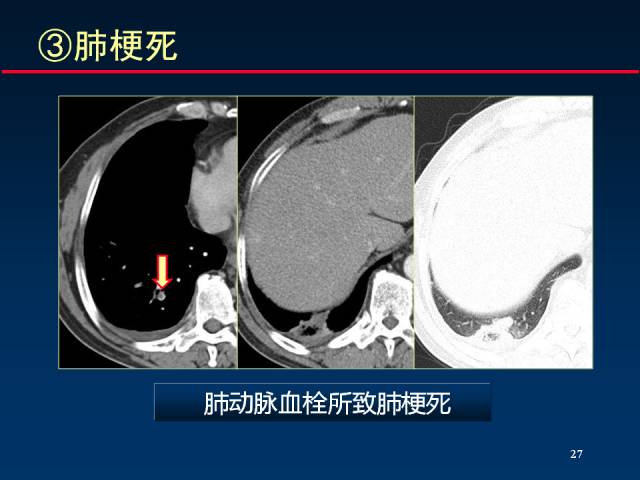 【PPT】肺实质与支气管——基本CT征象的定义与诠释