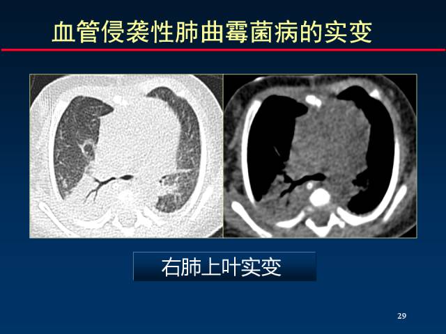 【PPT】肺实质与支气管——基本CT征象的定义与诠释