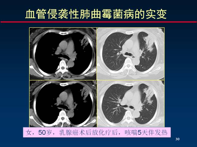 【PPT】肺实质与支气管——基本CT征象的定义与诠释