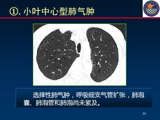 【PPT】肺实质与支气管——基本CT征象的定义与诠释