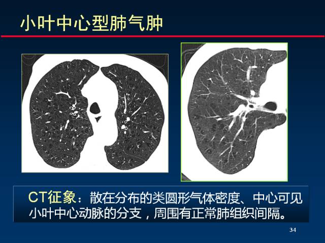 【PPT】肺实质与支气管——基本CT征象的定义与诠释