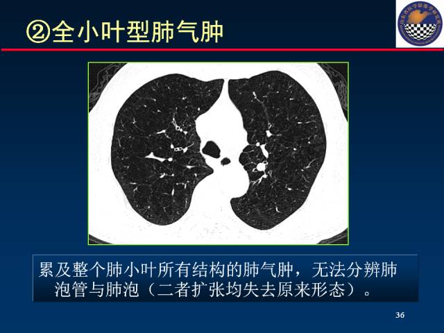 【PPT】肺实质与支气管——基本CT征象的定义与诠释