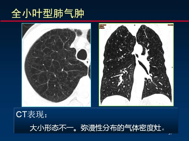 【PPT】肺实质与支气管——基本CT征象的定义与诠释