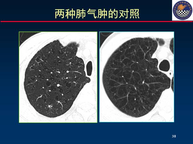 【PPT】肺实质与支气管——基本CT征象的定义与诠释