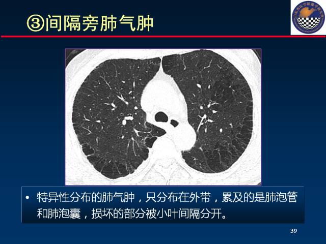 【PPT】肺实质与支气管——基本CT征象的定义与诠释