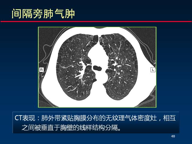 【PPT】肺实质与支气管——基本CT征象的定义与诠释