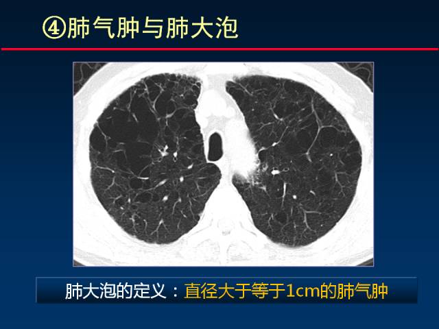 【PPT】肺实质与支气管——基本CT征象的定义与诠释