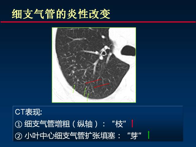 【PPT】肺实质与支气管——基本CT征象的定义与诠释