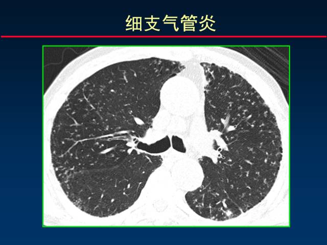【PPT】肺实质与支气管——基本CT征象的定义与诠释