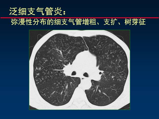 【PPT】肺实质与支气管——基本CT征象的定义与诠释