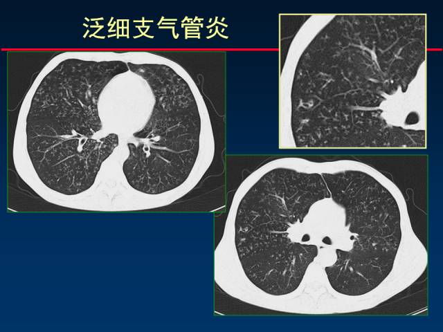 【PPT】肺实质与支气管——基本CT征象的定义与诠释