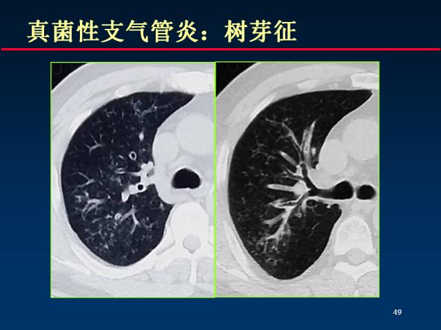 【PPT】肺实质与支气管——基本CT征象的定义与诠释