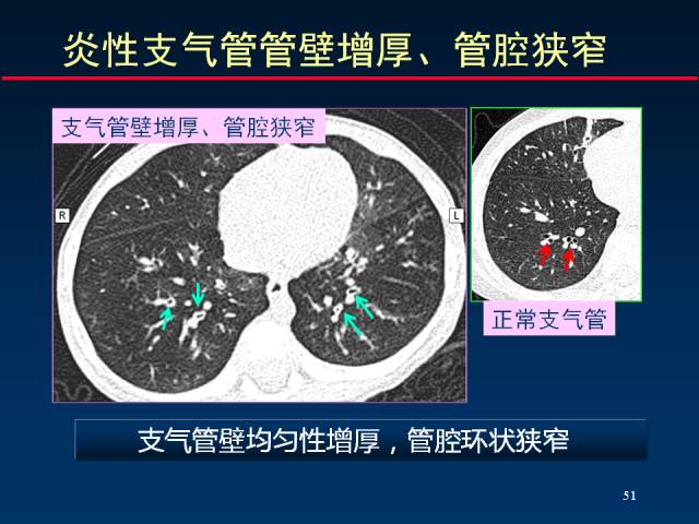 【PPT】肺实质与支气管——基本CT征象的定义与诠释
