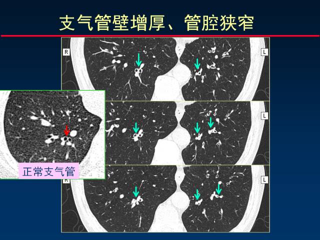 【PPT】肺实质与支气管——基本CT征象的定义与诠释
