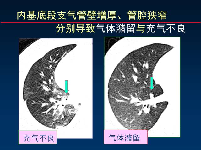 【PPT】肺实质与支气管——基本CT征象的定义与诠释