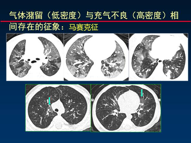 【PPT】肺实质与支气管——基本CT征象的定义与诠释