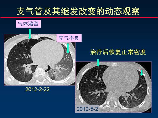 【PPT】肺实质与支气管——基本CT征象的定义与诠释