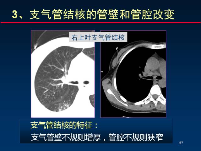 【PPT】肺实质与支气管——基本CT征象的定义与诠释