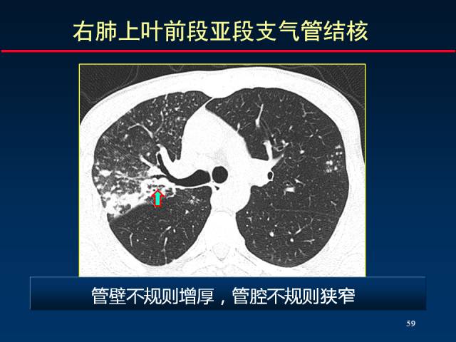 【PPT】肺实质与支气管——基本CT征象的定义与诠释