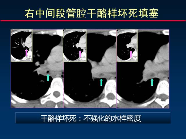 【PPT】肺实质与支气管——基本CT征象的定义与诠释