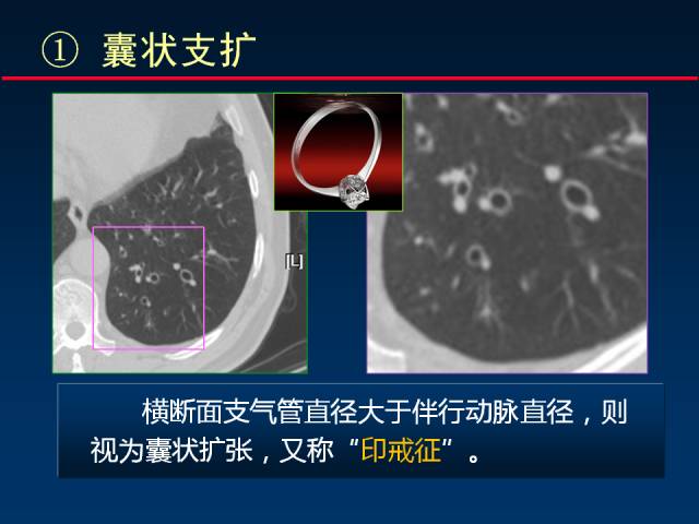 【PPT】肺实质与支气管——基本CT征象的定义与诠释