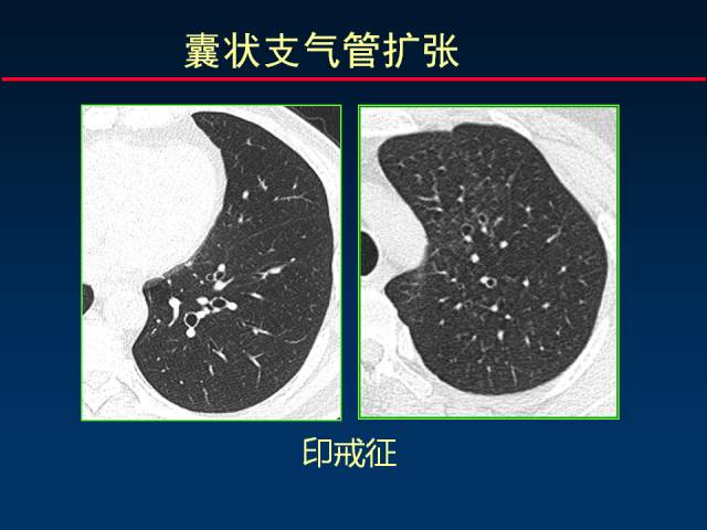 【PPT】肺实质与支气管——基本CT征象的定义与诠释